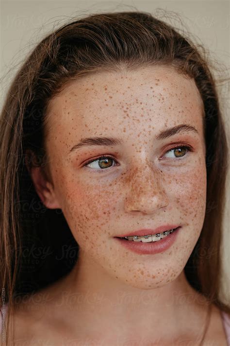 freckles and braces